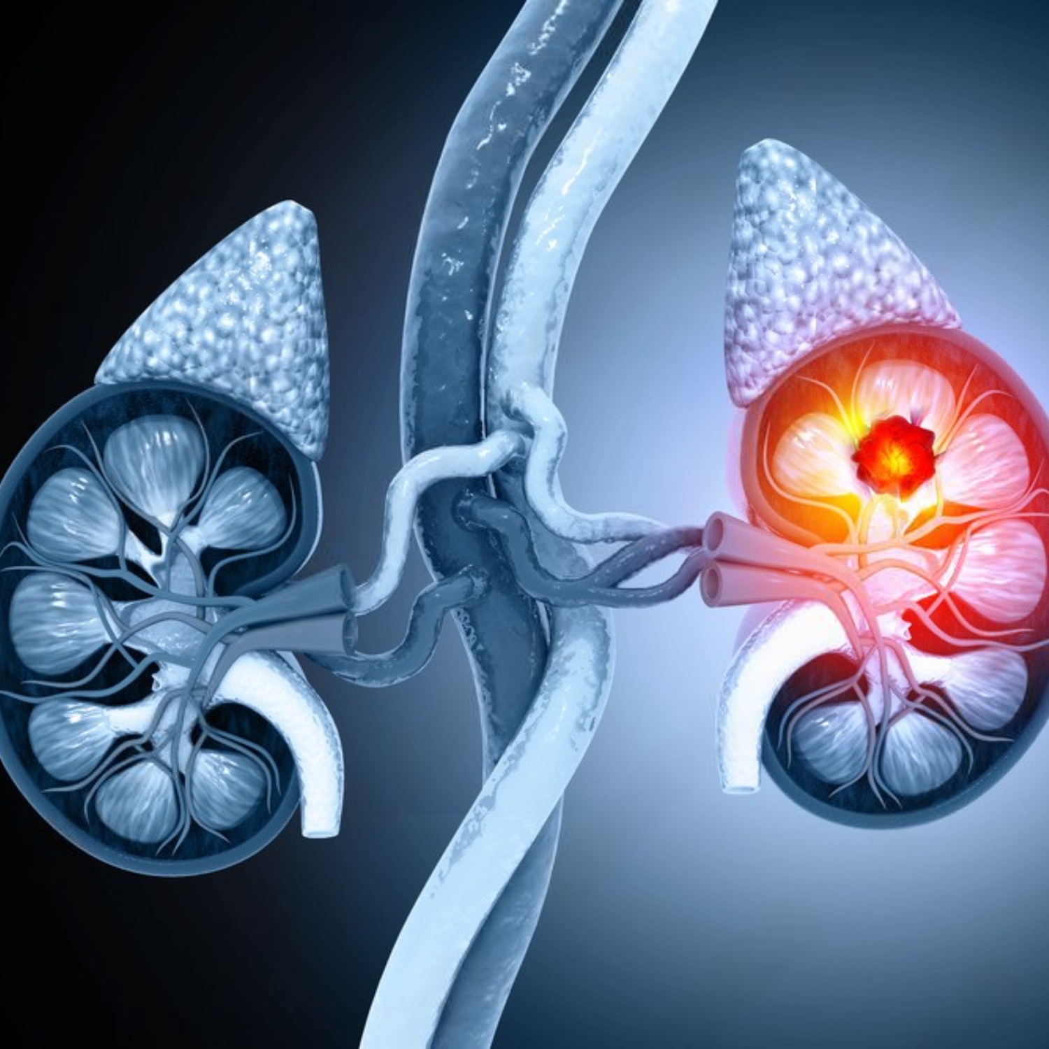 Ayurvedic treatment for Kidney Stones 